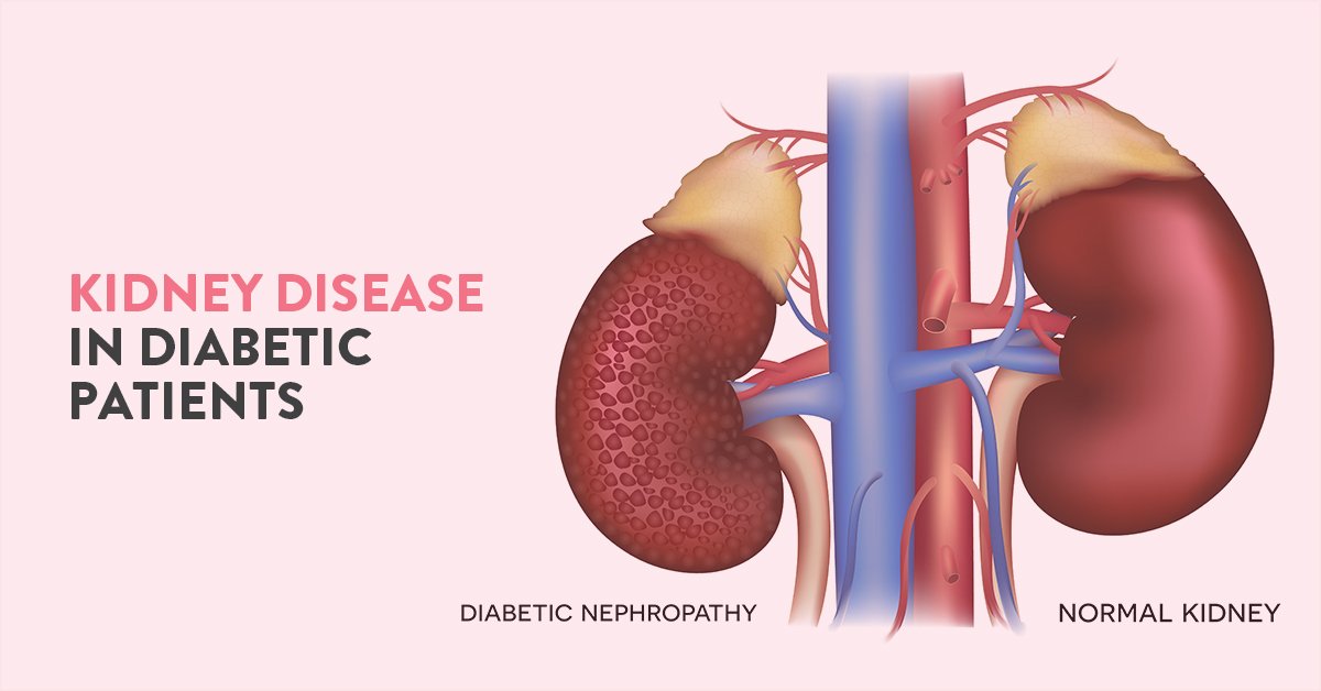 Understanding Diabetic Kidney Disease: Prevention, Management, and Hope ...